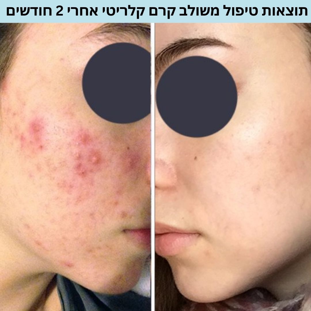 ערכת טיפול באקנה והבהרה – תמונה 4